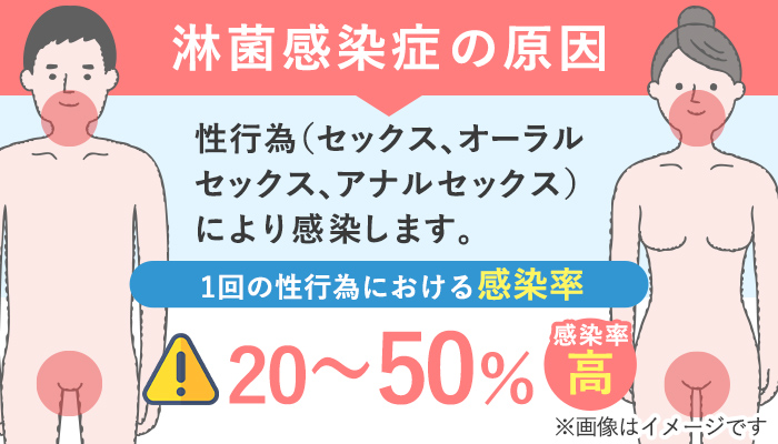 淋菌感染症(淋病)の原因と感染確率