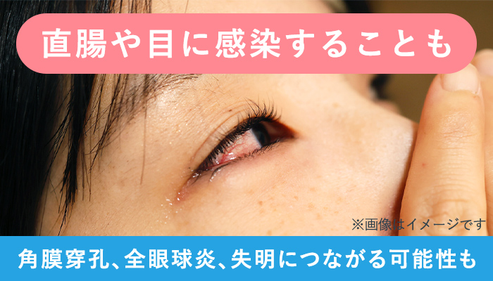 淋菌感染症(淋病)は直腸や目にも感染
