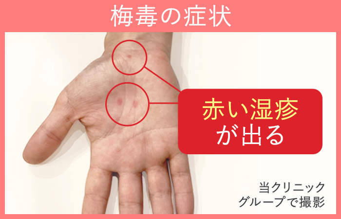 梅毒2期の症状であるバラ疹|男性の手のひらの症例写真