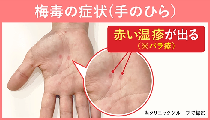 梅毒2期の症状であるバラ疹|男性の手のひらの症例写真