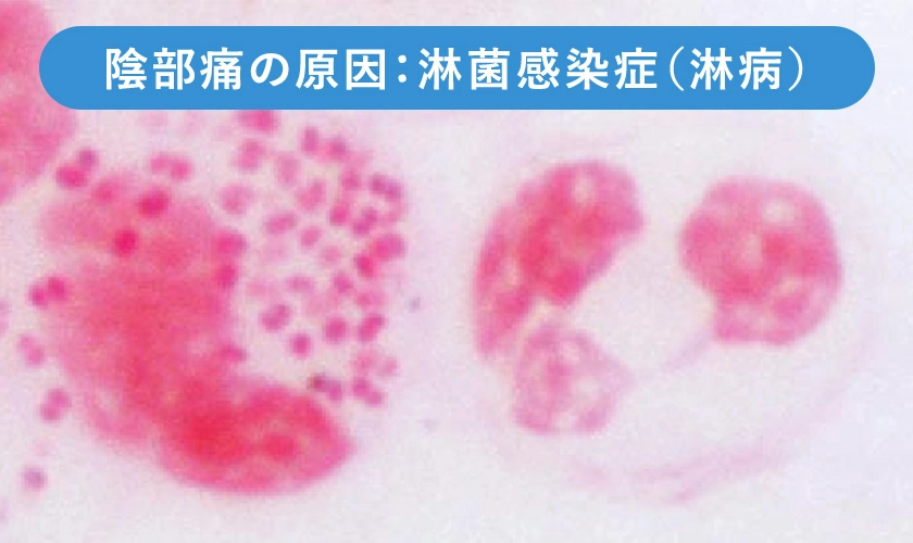 淋菌塗抹標本(グラム染色)