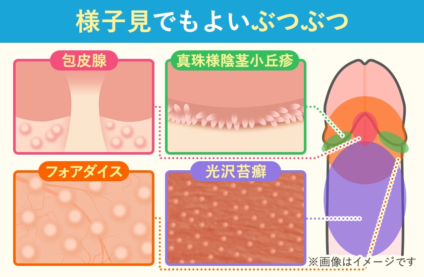様子見でもよい亀頭のぶつぶつの一覧