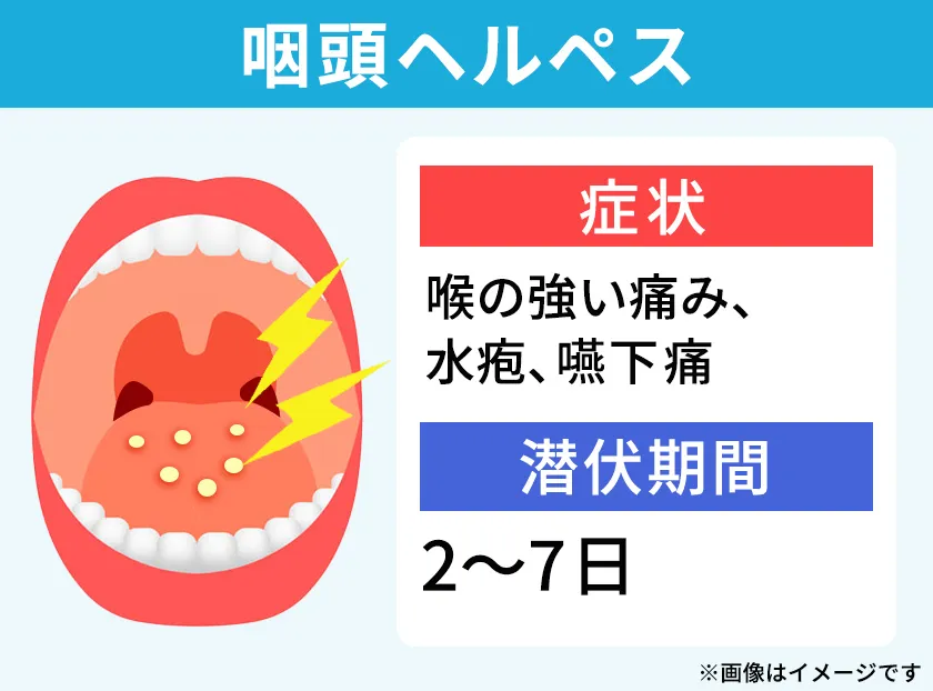 喉の強い痛みや水疱を引き起こす咽頭ヘルペス