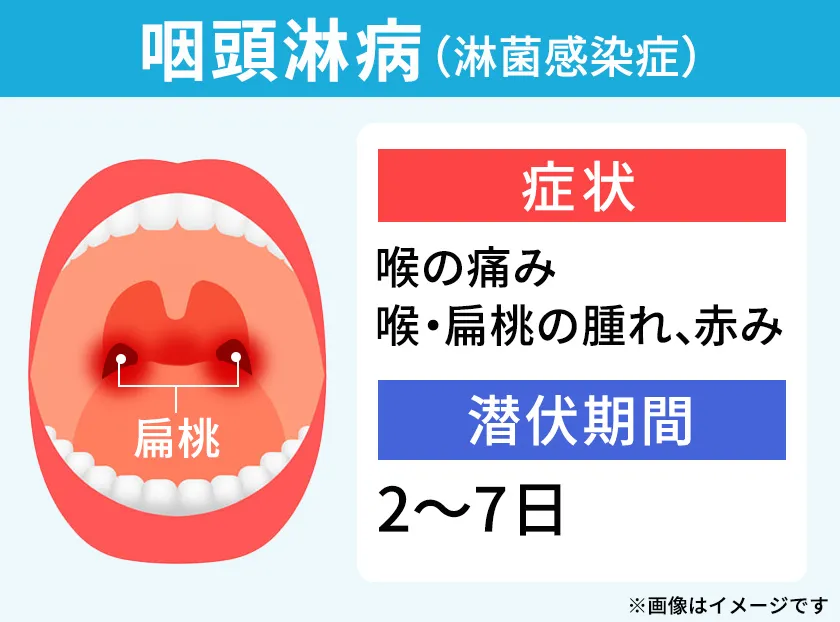 喉の痛みや腫れを引き起こす咽頭淋病