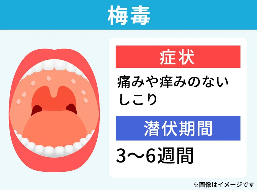 喉に痛みのないしこりができる梅毒