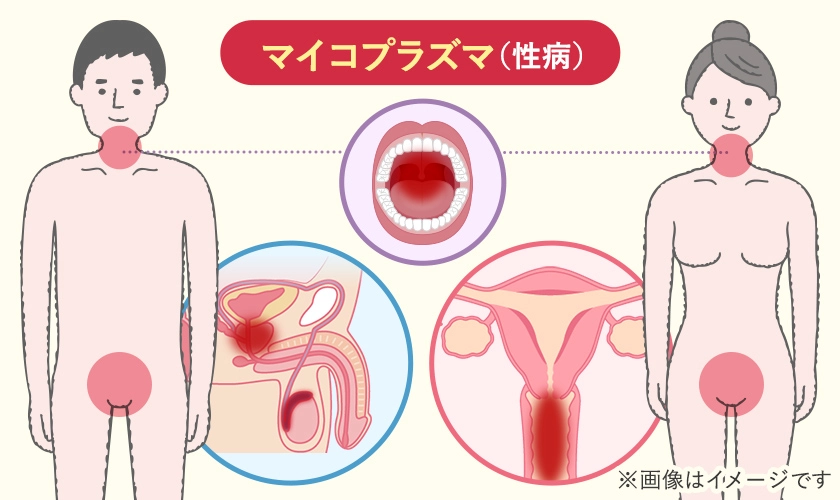 喉や陰部に症状を引き起こす性病のマイコプラズマ