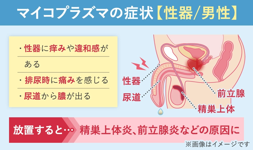 マイコプラズマ(性病)の男性の症状と発生部位