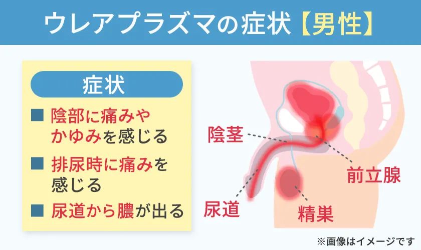男性のウレアプラズマの症状と発生部位