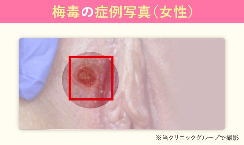 女性の梅毒の症状の写真