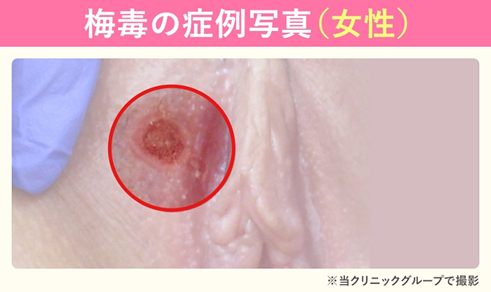 女性陰部の梅毒症状の症例写真