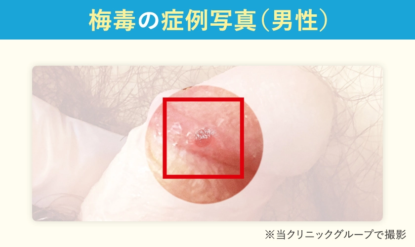 男性の梅毒の初期硬結の症状の写真