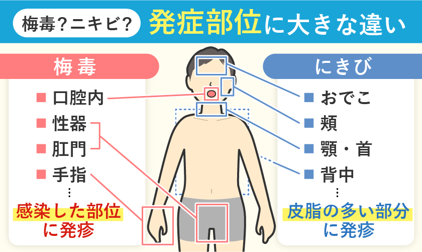 梅毒とニキビの違い
