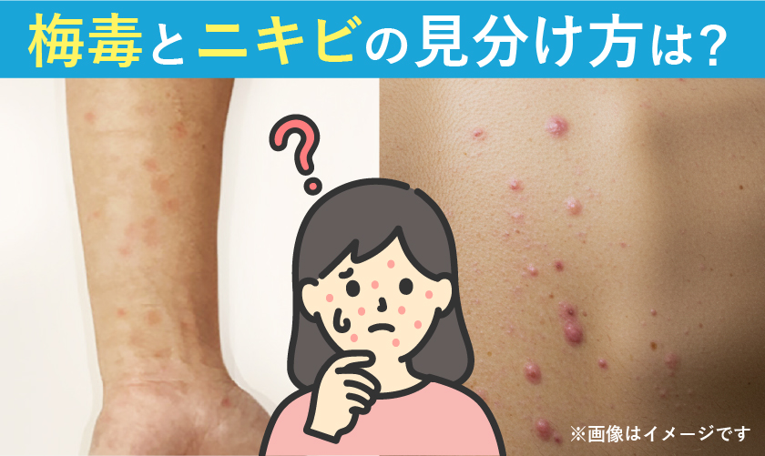 梅毒とニキビの見分け方