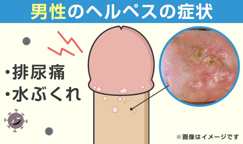 男性のヘルペスの症状と症例写真