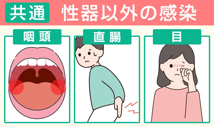 淋菌感染症(淋病)の性器以外の症状 咽頭・直腸・目などにも感染