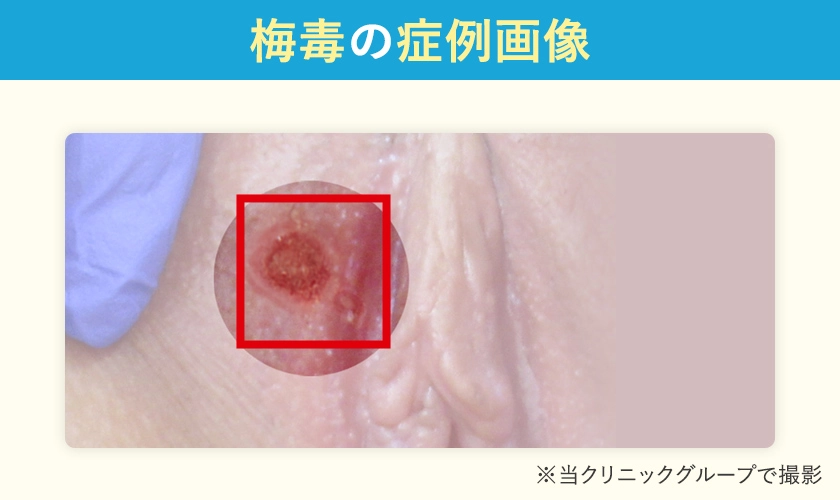 梅毒の症例画像