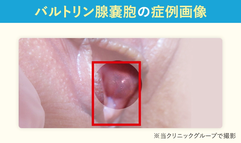 バルトリン線嚢胞の症例画像